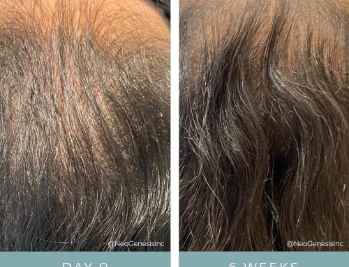 Hair Loss + Microneedling