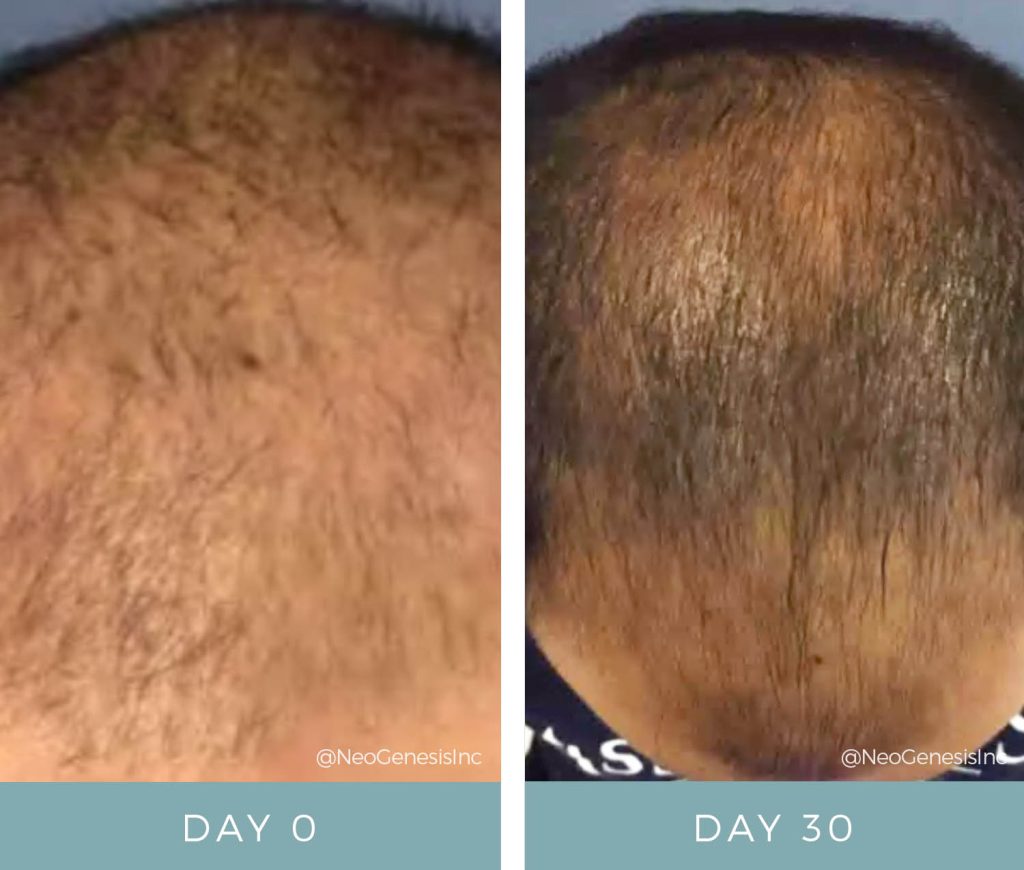 Before + After - Hair Loss