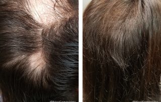 Before + After - Alopecia Arietta