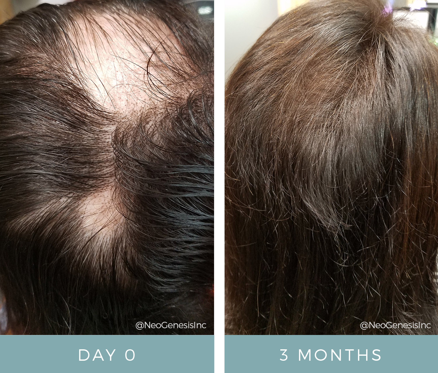 Before + After - Alopecia Arietta