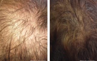 Before + After - Hair Loss