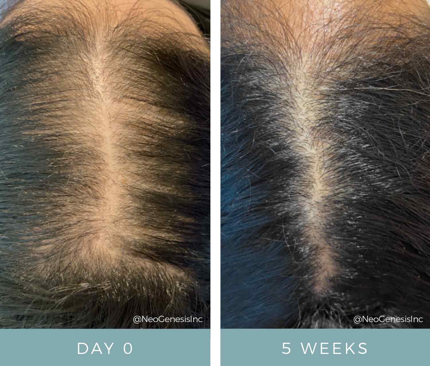 Before + After - Hair Loss + Microneedling