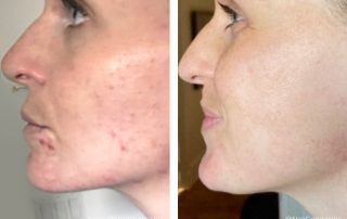 Before + After - Hormonal Acne