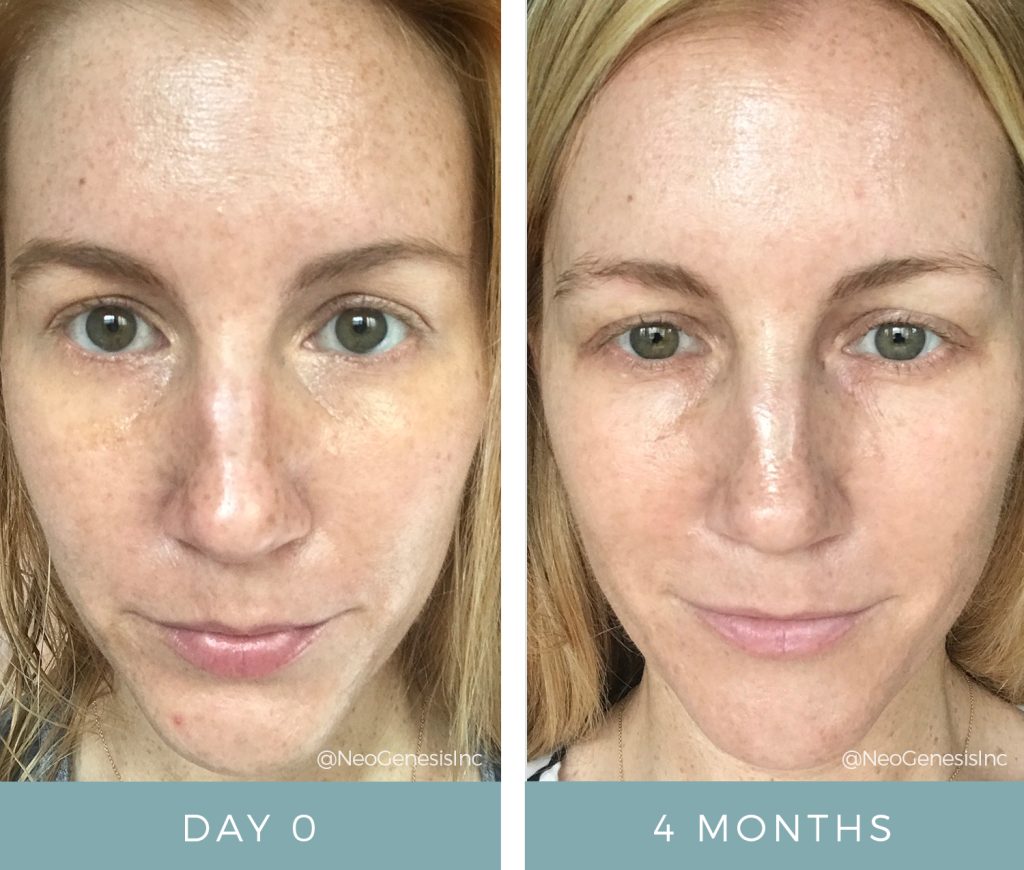 Before + After - Hyperpigmentation