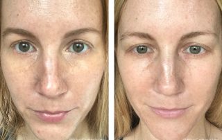 Before + After - Hyperpigmentation