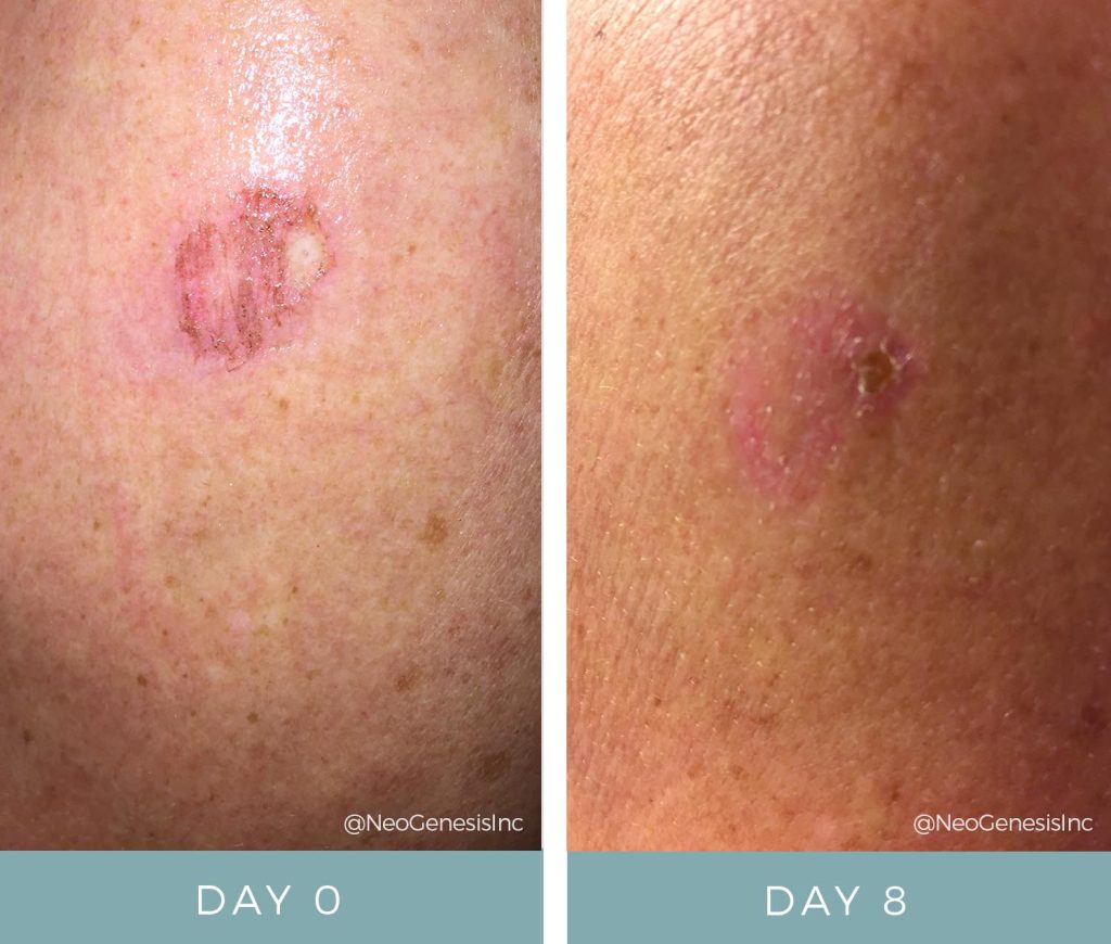 Before + After - Melanoma Skin Cancer