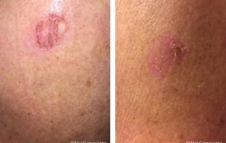 Before + After - Melanoma Skin Cancer