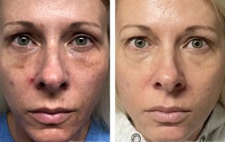 Before + After - Melasma