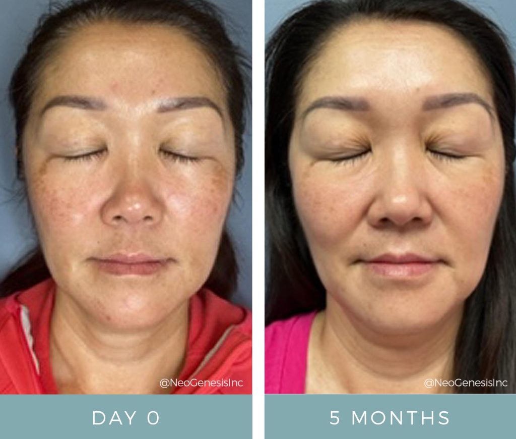 Before + After - Melasma + Sun Damage + PIH