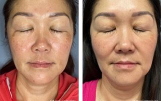 Before + After - Melasma + Sun Damage + PIH