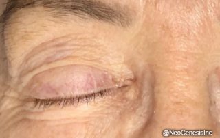 Before - Ageing Skin + Microcurrent