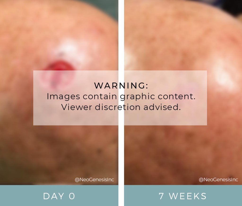 Before + After - Skin Cancer - Mohs Surgery