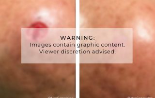 Before + After - Skin Cancer - Mohs Surgery