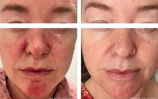 Before + After - Perioral Dermatitis