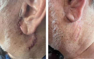 Before + After - Cancer Surgery