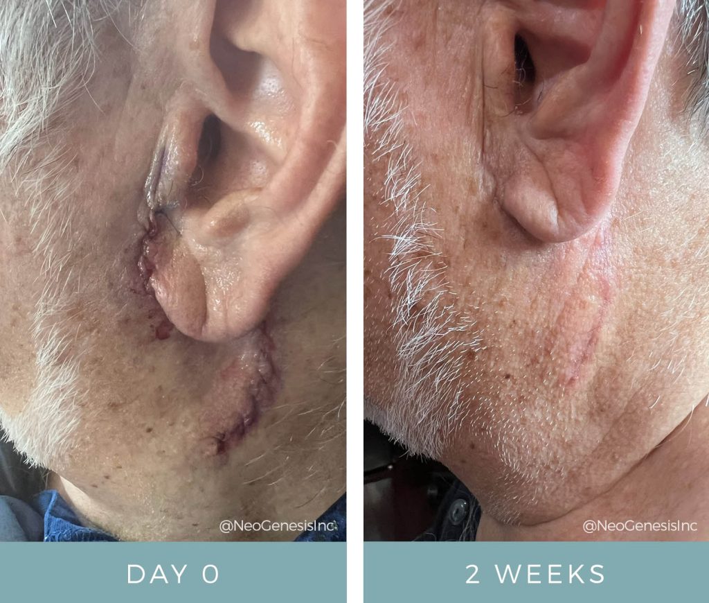 Before + After - Cancer Surgery Scar Reduction