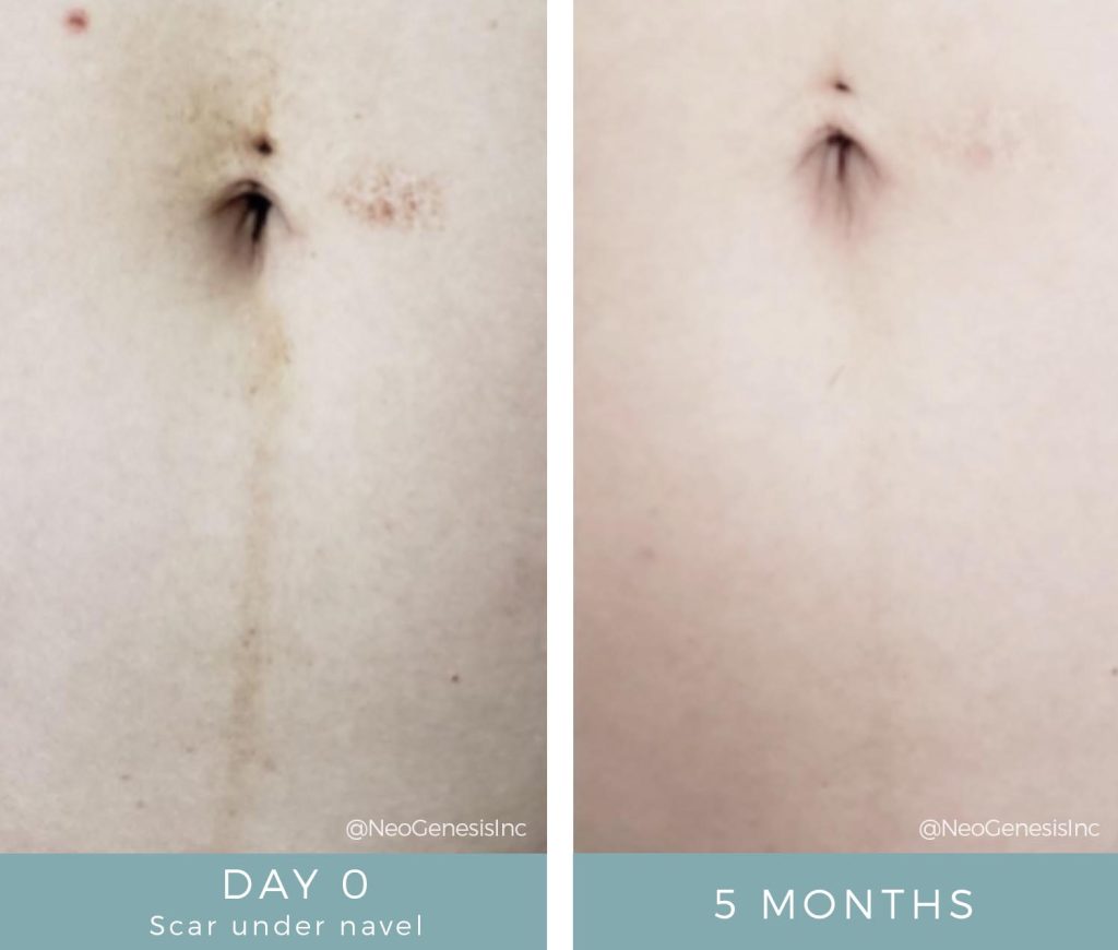 Before + After - Post-Pregnancy Scarring