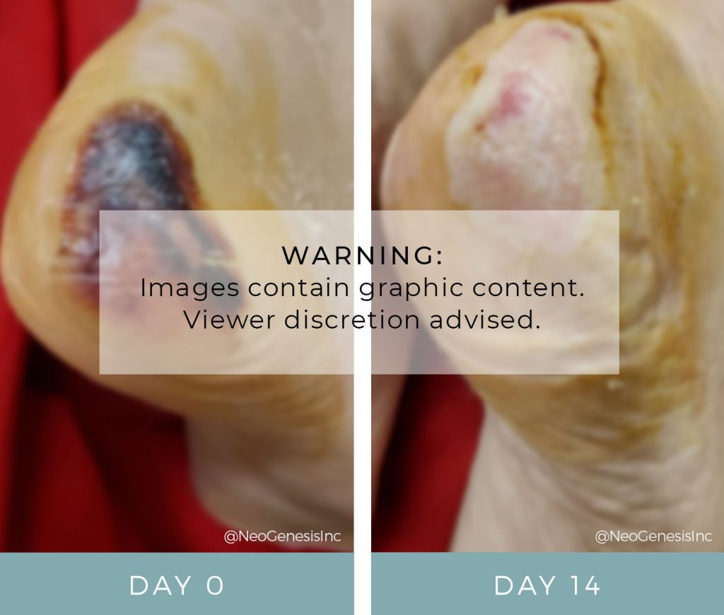 Before + After - Pressure Ulcers