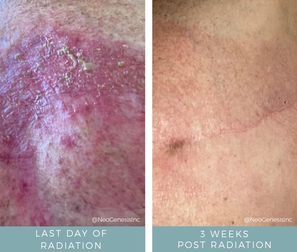 Before + After - Radiation Burns