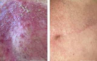 Before + After - Radiation Burns