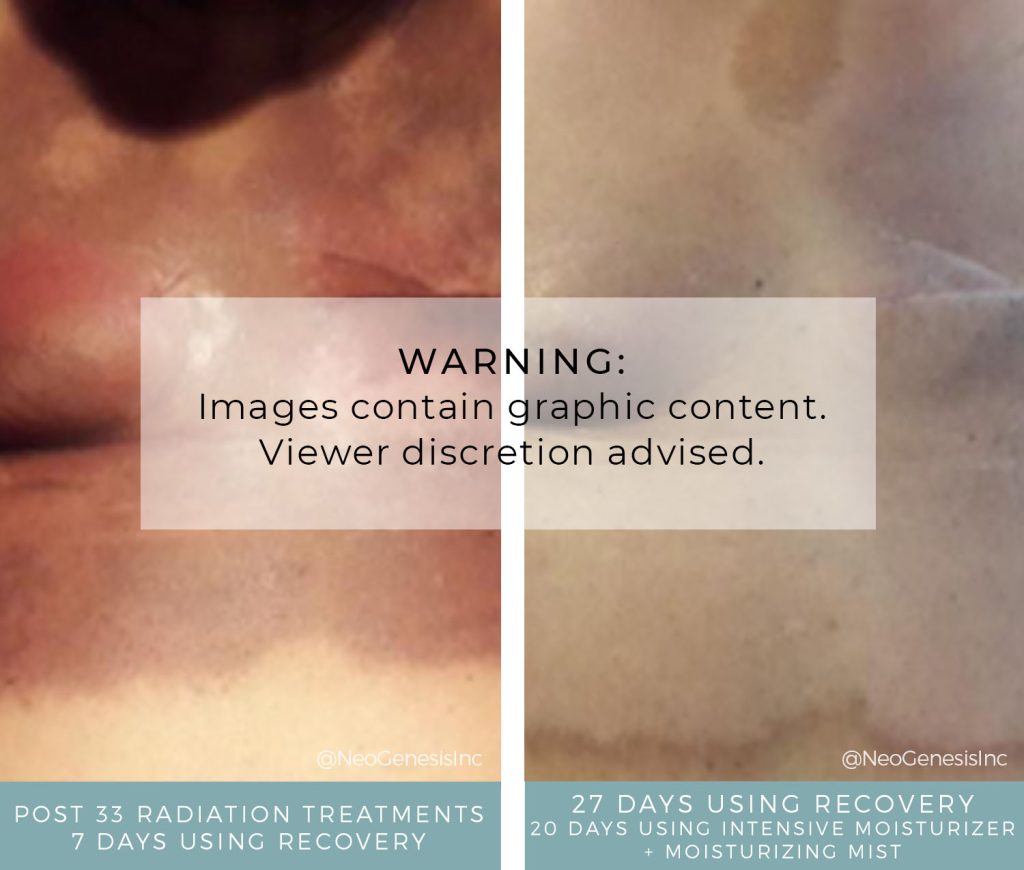 Before + After - Radiation Burns