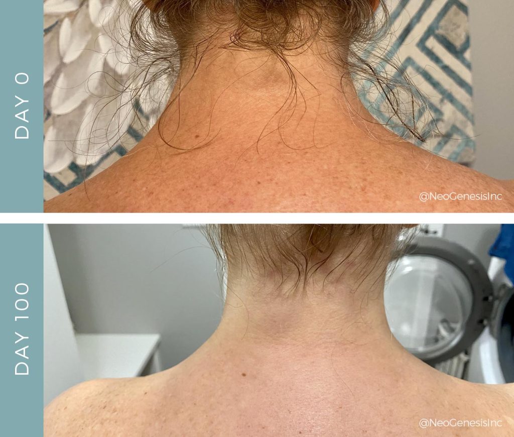 Before + After - Radiation + Chemotherapy