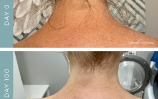 Before + After - Radiation + Chemotherapy