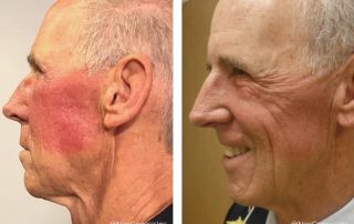 Before + After - Radiation