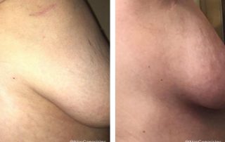 Before + After - Radiation for Breast Cancer