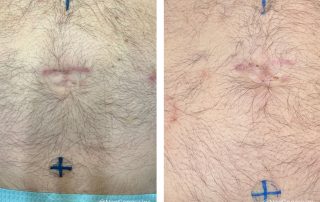 Before + After - Radiation for Prostate Cancer