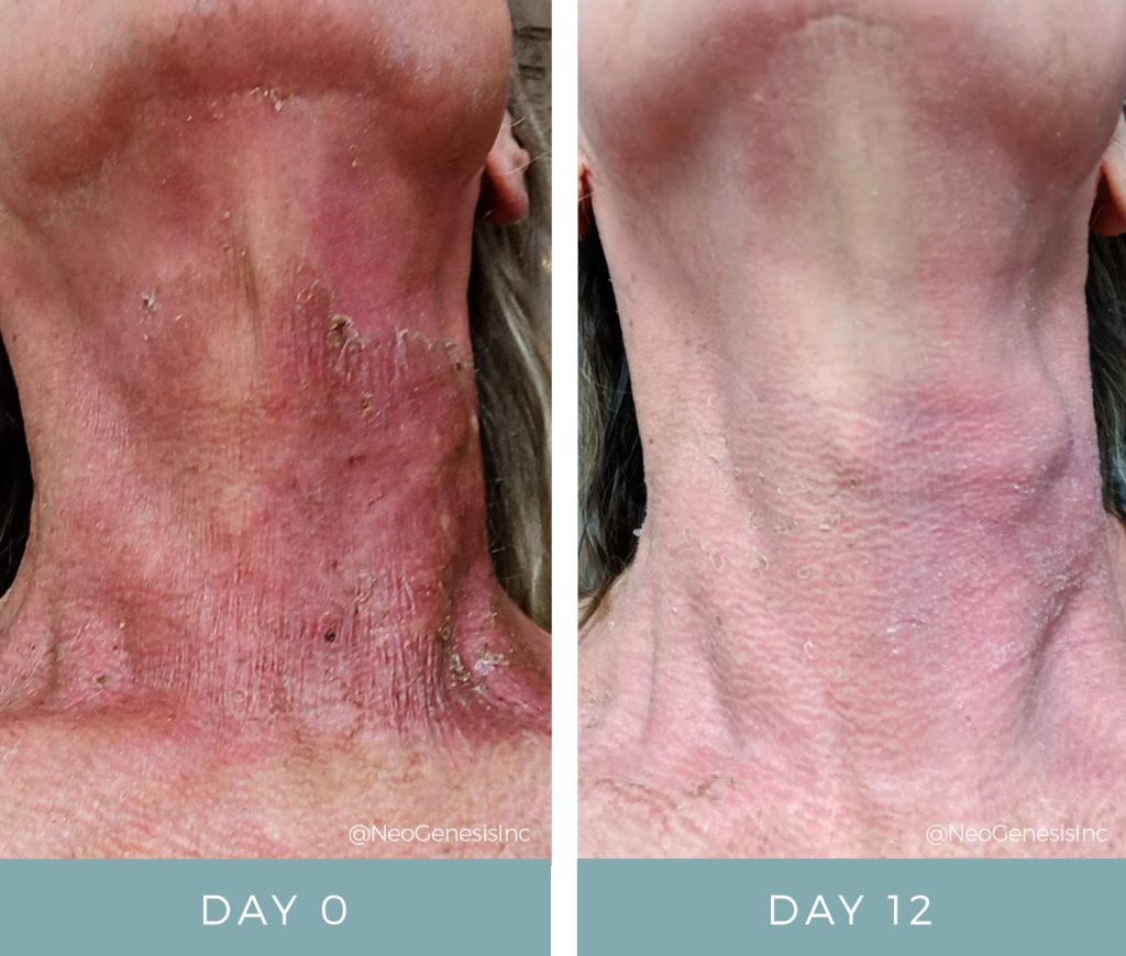 Before + After - Radiation Burns