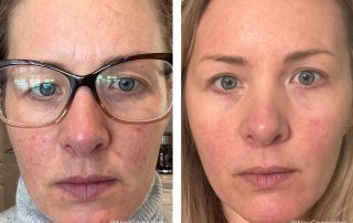 Before + After - Rosacea