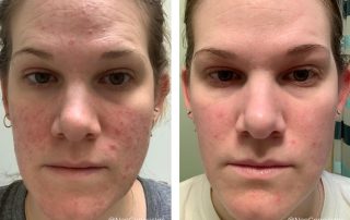 Before + After - Rosacea