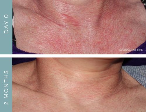 Permanent Diffused Redness (Rosacea)