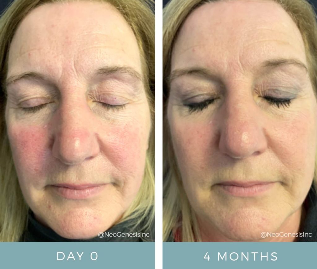 Before + After - Rosacea + Ageing Skin + Hyperpigmentation