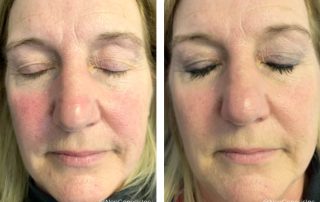 Before + After - Rosacea + Ageing Skin + Hyperpigmentation