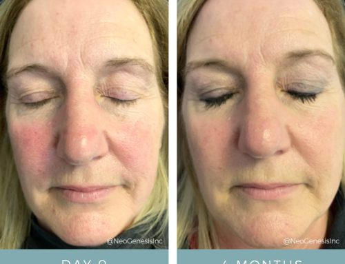 Rosacea + Ageing Skin + Hyperpigmentation