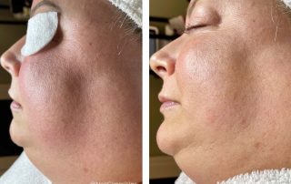 Before + After - Rosacea + Ageing Skin