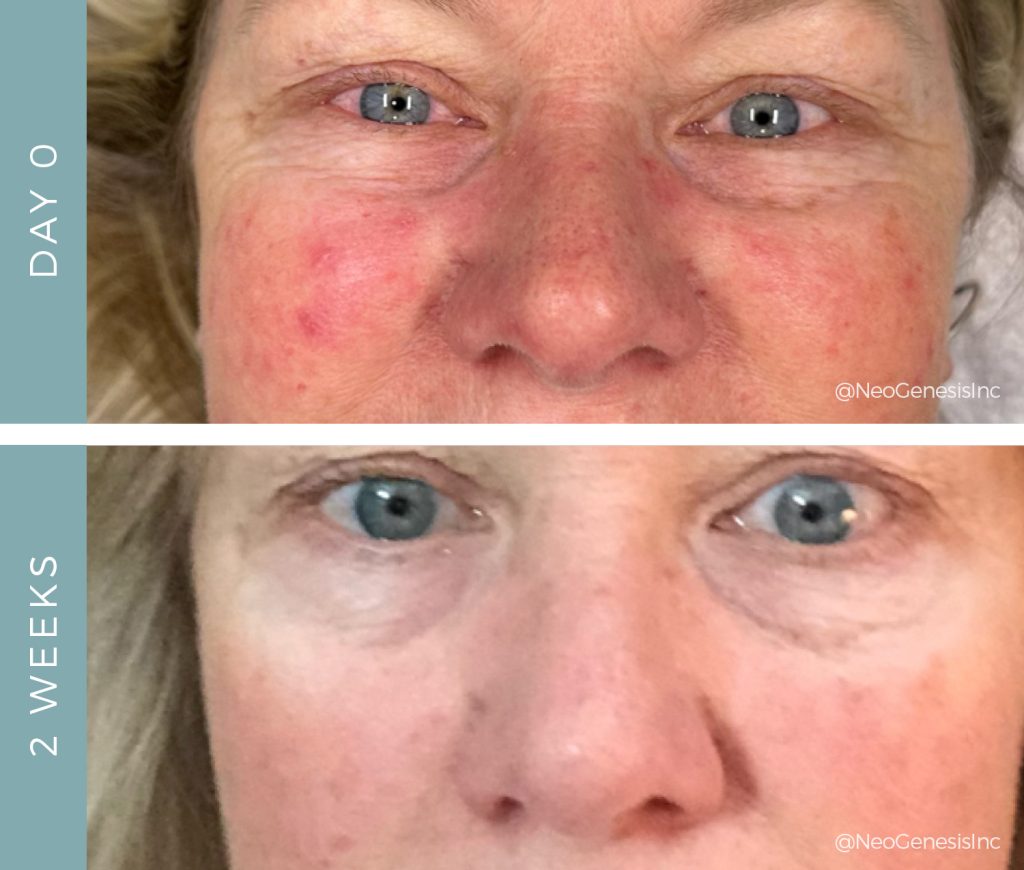 Before + After - Rosacea