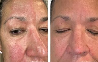 Before + After - Rosacea + Seborrheic Dermatitis