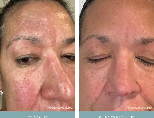 Rosacea + Seborrheic Dermatitis