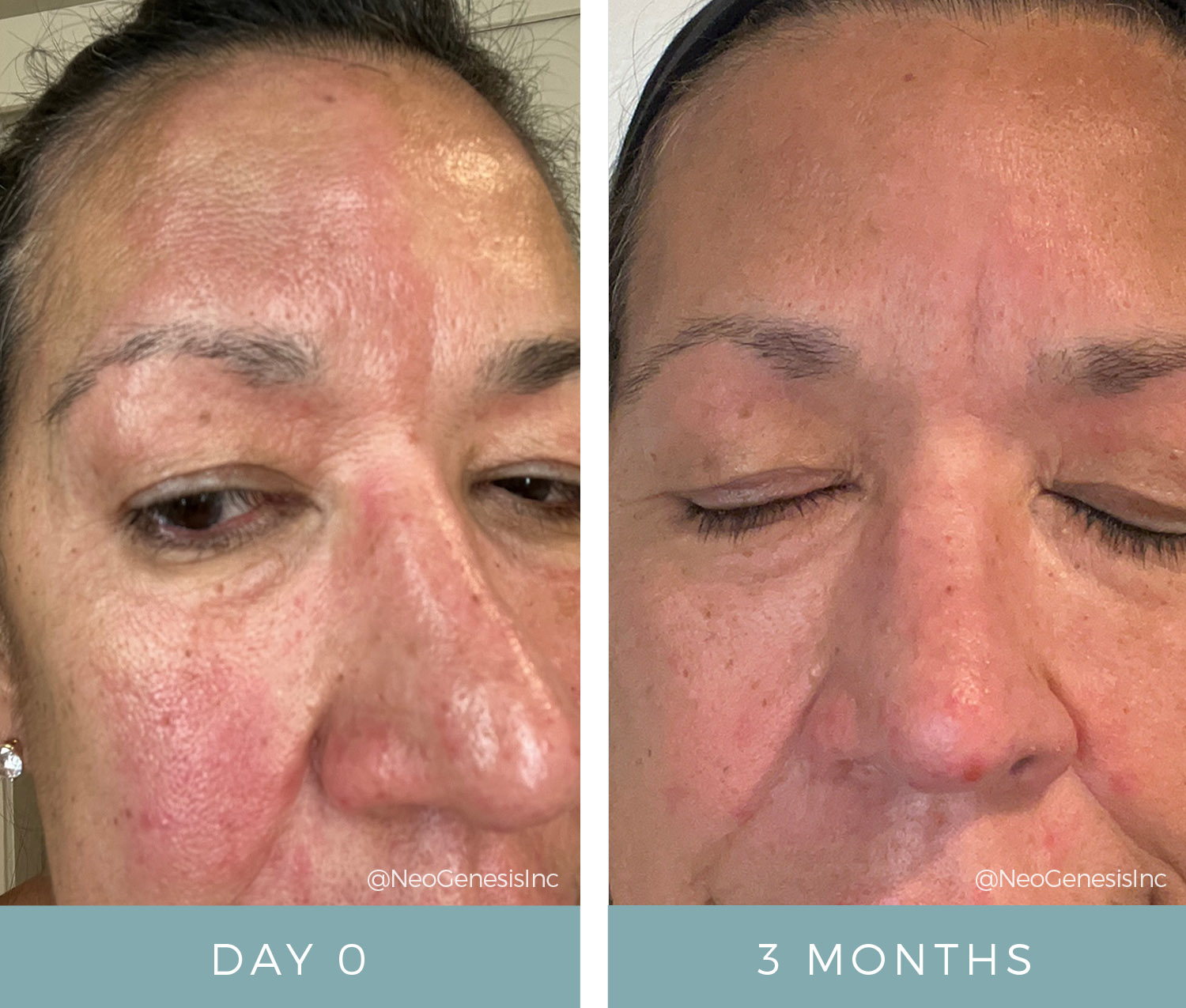 Before + After - Rosacea + Seborrheic Dermatitis