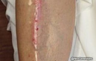 Before - Scarring