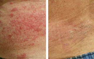 Before + After - Shingles