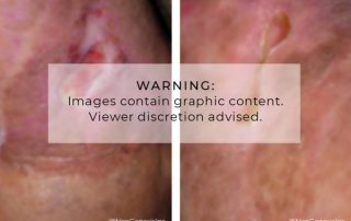Before + After - Diabetic Ulcers