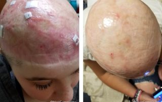 Before + After - Wound Care for a Scalp Injury