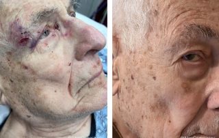 Before + After - Wound Care