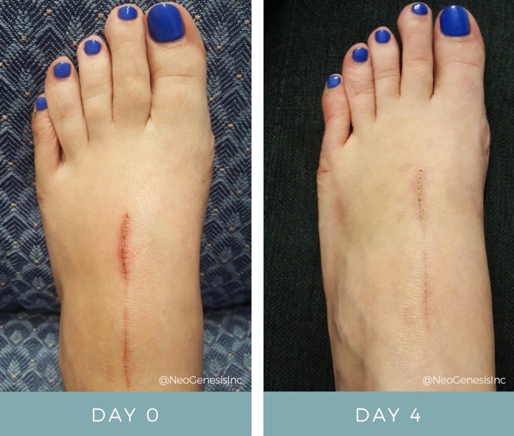 Before + After - Wound Care + Scarring