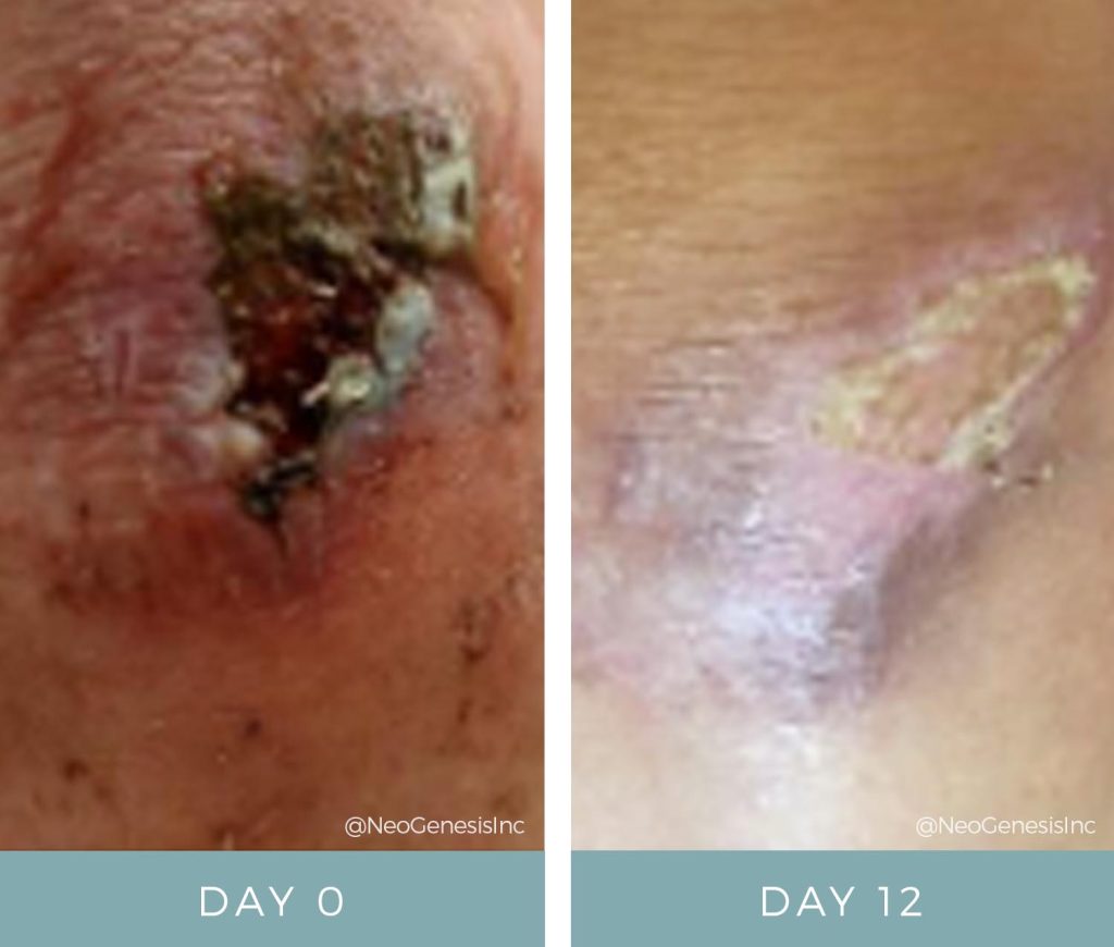 Before + After - Wound Care + Scarring