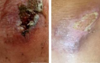 Before + After - Wound Care + Scarring